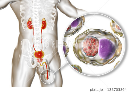 Chlamydiosis infection in man Chlamydiosis infection in man 128703864