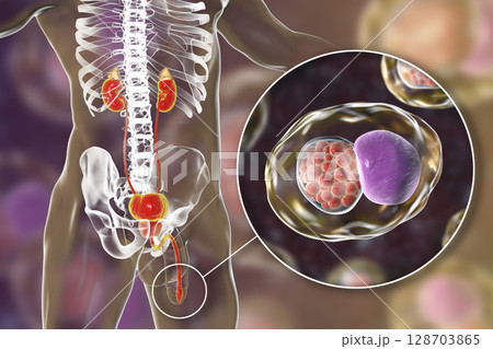 Chlamydiosis infection in man Chlamydiosis infection in man 128703865