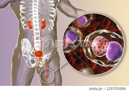 Chlamydiosis infection in man 128703866