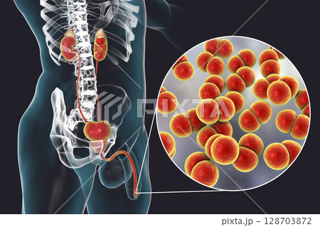 Male gonorrhea, medical concept 128703872