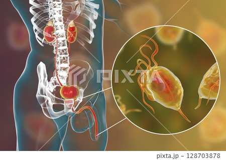 Trichomoniasis infection in man 128703878