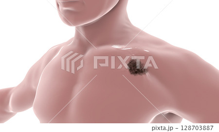 Melanoma on a male body 128703887