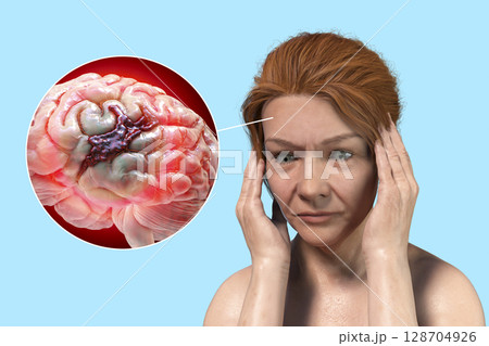 Stroke, conceptual illustration showing woman with acute headache and rupture of brain blood vessel Stroke, conceptual illustration showing woman with acute headache and rupture of brain blood vessel 128704926