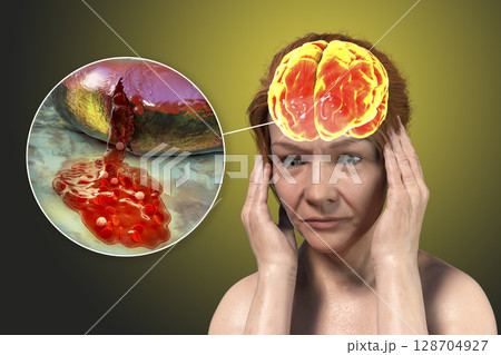 Stroke, conceptual illustration showing woman with acute headache and rupture of brain blood vessel 128704927