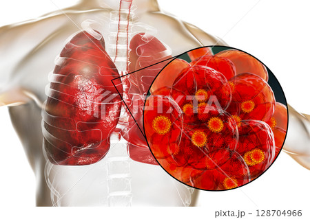 SARS-CoV-2 viruses in alveoli of human lungs causing COVID-19. Novel Coronavirus 128704966