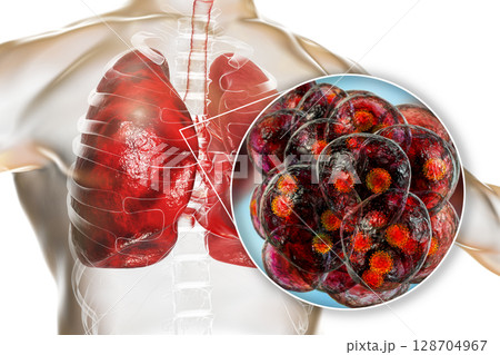 SARS-CoV-2 viruses in alveoli of human lungs causing COVID-19. Novel Coronavirus SARS-CoV-2 viruses in alveoli of human lungs causing COVID-19. Novel Coronavirus 128704967