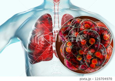 SARS-CoV-2 viruses in alveoli of human lungs causing COVID-19. Novel Coronavirus SARS-CoV-2 viruses in alveoli of human lungs causing COVID-19. Novel Coronavirus 128704970