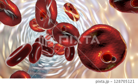 The malaria-infected red blood cells The malaria-infected red blood cells 128705121
