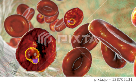 The malaria-infected red blood cell 128705131