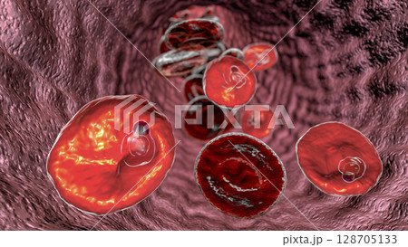 The malaria-infected red blood cell The malaria-infected red blood cell 128705133