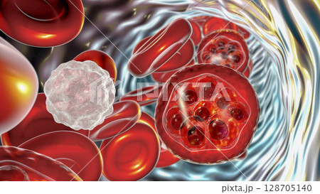 Red blood cell infected with malaria parasite 128705140