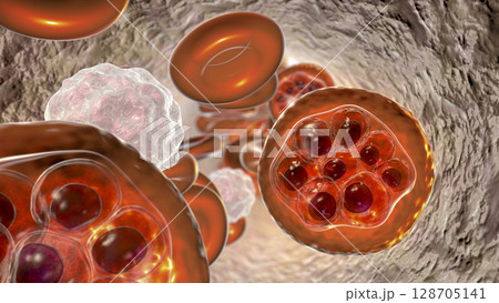 Red blood cell infected with malaria parasite 128705141