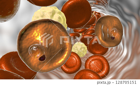 Red blood cell infected with malaria parasite Plasmodium vivax, ring stage Red blood cell infected with malaria parasite Plasmodium vivax, ring stage 128705151