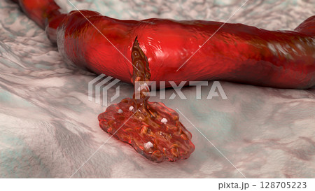 Hemorrhage, blood flowing from the damaged blood vessel, 3D illustration Hemorrhage, blood flowing from the damaged blood vessel, 3D illustration 128705223