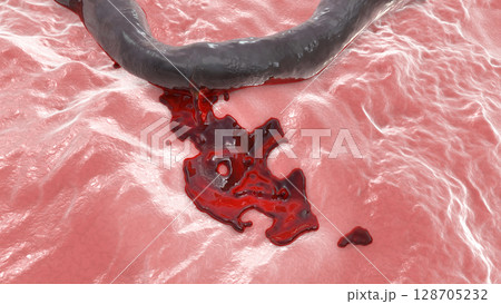 Hemorrhage, blood flowing from the damaged blood vessel, 3D illustration 128705232