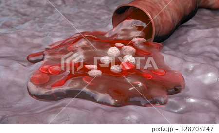 Blood flow, hemorrhage Blood flow, hemorrhage 128705247