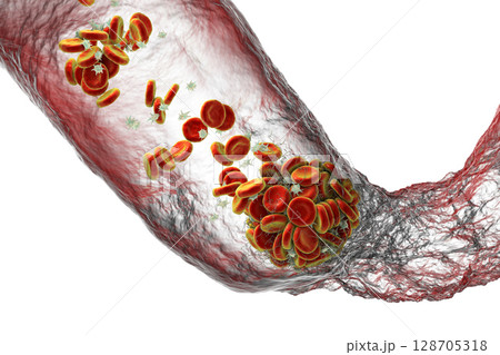 Blood clot made of red blood cells, platelets and fibrin protein strands. Thrombus 128705318