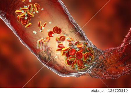 Blood clot made of red blood cells, platelets and fibrin protein strands. Thrombus 128705319