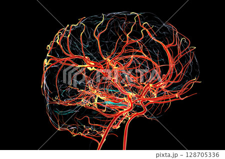 A saccular brain aneurysm, 3D illustration A saccular brain aneurysm, 3D illustration 128705336