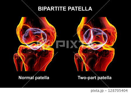 Bipartite patella, a condition where the kneecap has an unfused accessory ossification center, usually superolateral, 3D illustration. Bipartite patella, a condition where the kneecap has an unfused accessory ossification center, usually superolateral, 3D illustration. 128705404