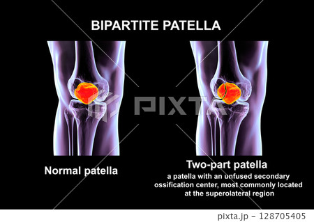 Bipartite patella, a condition where the kneecap has an unfused accessory ossification center, usually superolateral, 3D illustration. Bipartite patella, a condition where the kneecap has an unfused accessory ossification center, usually superolateral, 3D illustration. 128705405