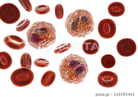 Eosinophilia, blood smear showing multiple eosinophils surround by red blood cells Eosinophilia, blood smear showing multiple eosinophils surround by red blood cells 128705483