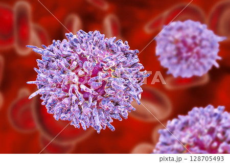 Hairy cell leukemia 128705493