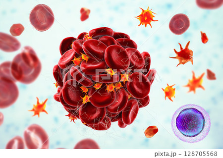 Blood clot made of red blood cells, platelets and fibrin protein strands. Thrombus 128705568