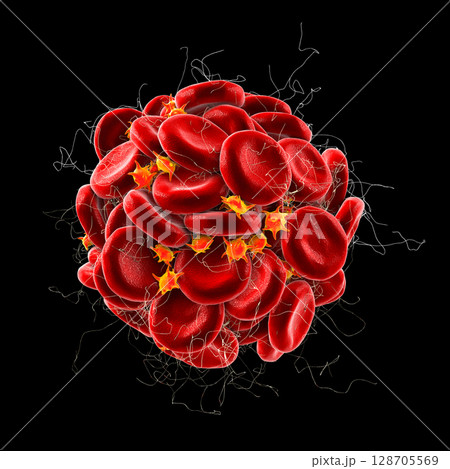 Blood clot made of red blood cells, platelets and fibrin protein strands. Thrombus 128705569