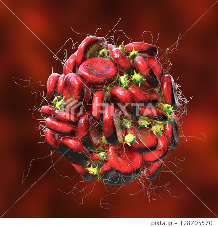 Blood clot made of red blood cells, platelets and fibrin protein strands. Thrombus 128705570