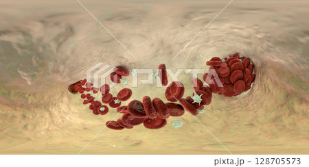Blood clot, 360 degree panorama view 128705573