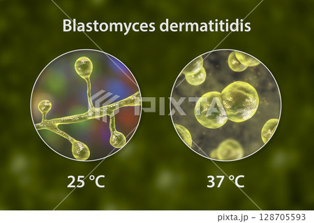 Blastomyces dermatitidis fungi Blastomyces dermatitidis fungi 128705593