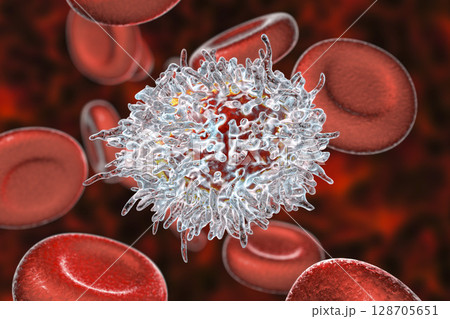 Hairy cell leukemia 128705651