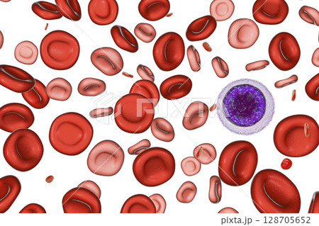 Iron deficiency anemia Iron deficiency anemia 128705652