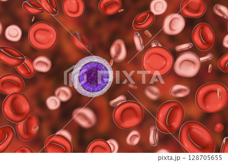 Iron deficiency anemia 128705655