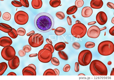 Iron deficiency anemia 128705656