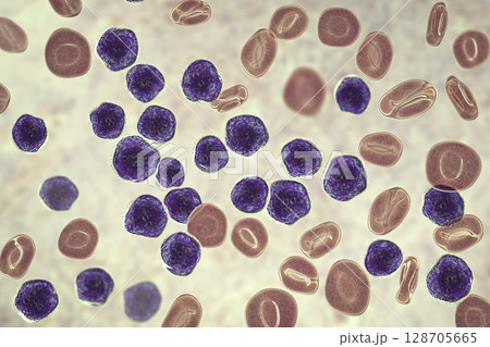 Acute lymphoblastic leukemia, bone marrow smear 128705665