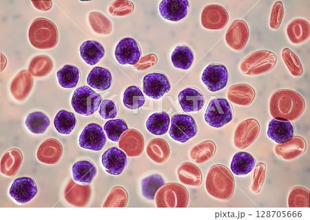 Acute lymphoblastic leukemia, bone marrow smear 128705666