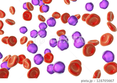 Acute lymphoblastic leukemia 128705667