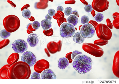 Acute lymphoblastic leukemia Acute lymphoblastic leukemia 128705674