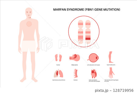 Marfan syndrome poster 128719956