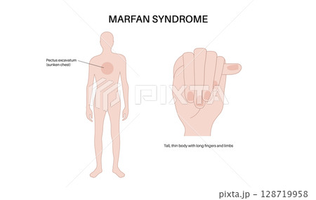 Marfan syndrome poster 128719958