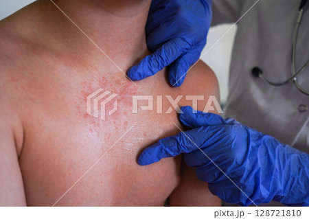 A doctor in blue gloves examines the rash on the boy's body. 128721810