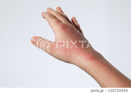 Red rashes from Coxsackie virus on a child hand on a white background. Chicken pox allergy symptoms on skin on children's body 128729164