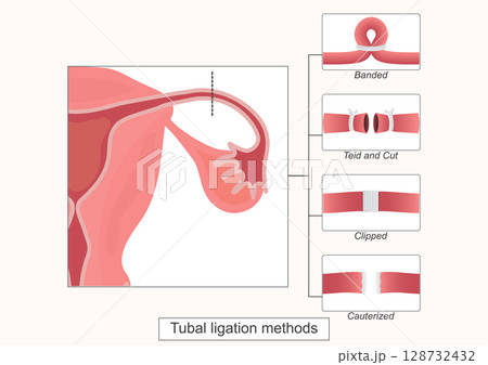 Tubal ligation often called getting tubes tied. 128732432