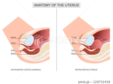 Anteverted uterus different than a retroverted uterus.Retroverted uterus. Anteverted uterus different than a retroverted uterus.Retroverted uterus. 128732438