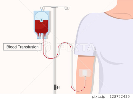 Blood transfusion is a common procedure in which donated blood . Blood transfusion is a common procedure in which donated blood . 128732439