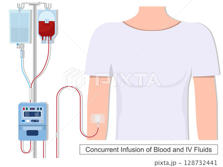 Concurrent infusions are the simultaneous infusion of multiple drugs. 128732441