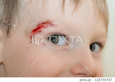 boy with a head wound 128736787