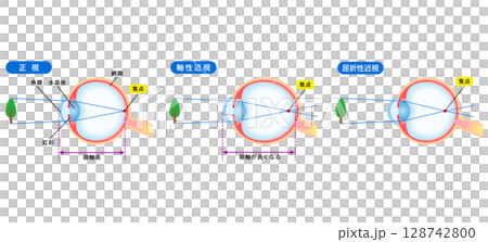 Structure of the eye, normal vision, axial myopia, refractive myopia, visual acuity Structure of the eye, normal vision, axial myopia, refractive myopia, visual acuity 128742800